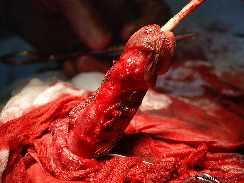 instalacja matrixu kolagenowego na powiększenie penisa