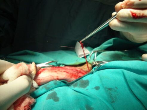 operacja powiększania penisa