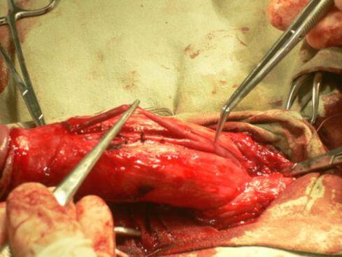 wykonanie operacji powiększenia penisa